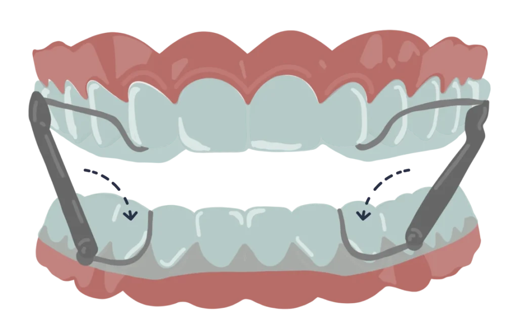 le guedard bielles mise en place