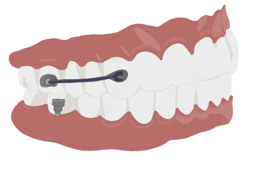 le guedard motion sans elastiques