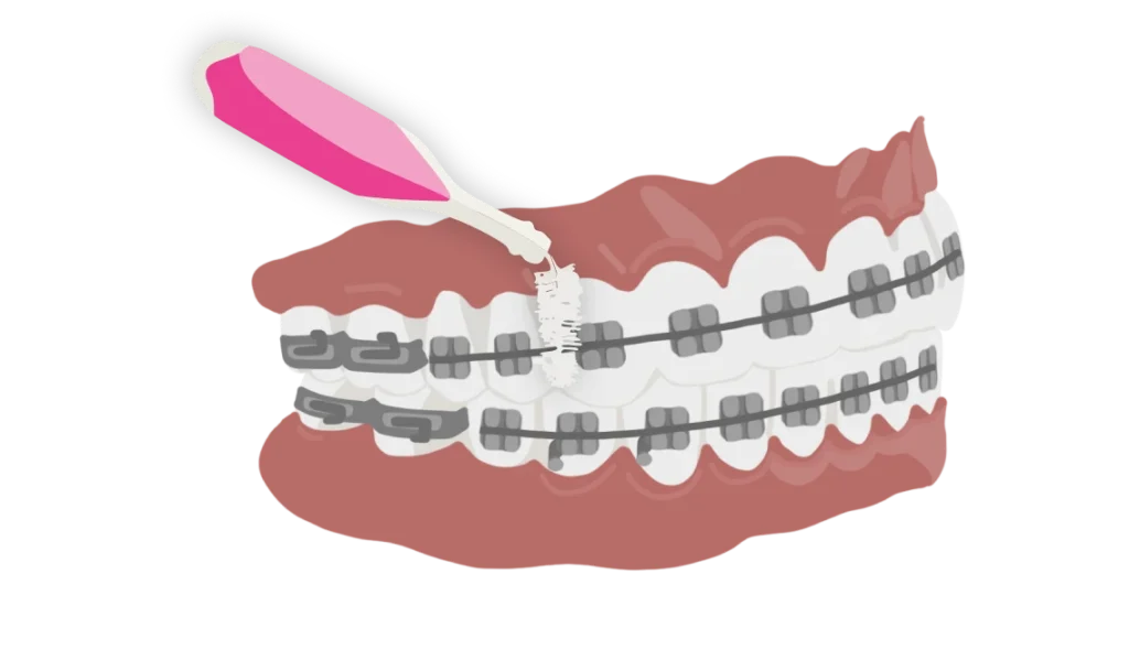 le guedard multibagues etape brossage brossette 01