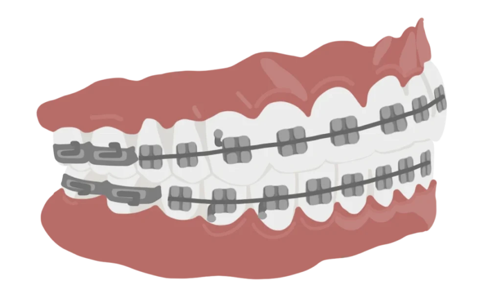 le guedard multibagues vue de profil