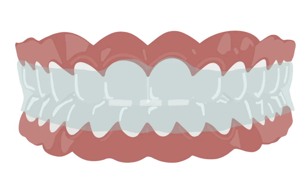 le guedard orthodontie rennes contention positionneur en place
