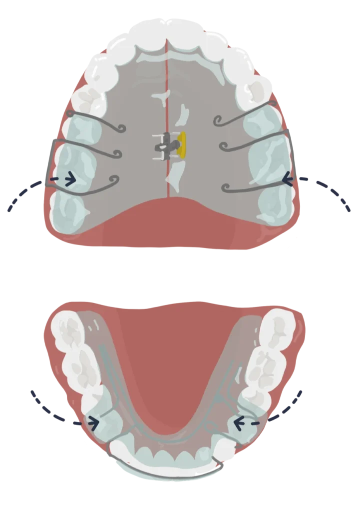 le guedard othodontiste saint gregoire appareil interception twin bloc mise en place