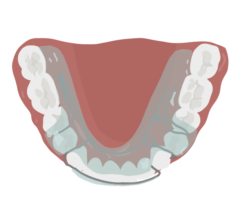 le guedard othodontiste saint gregoire appareil interception twin bloc vue bas