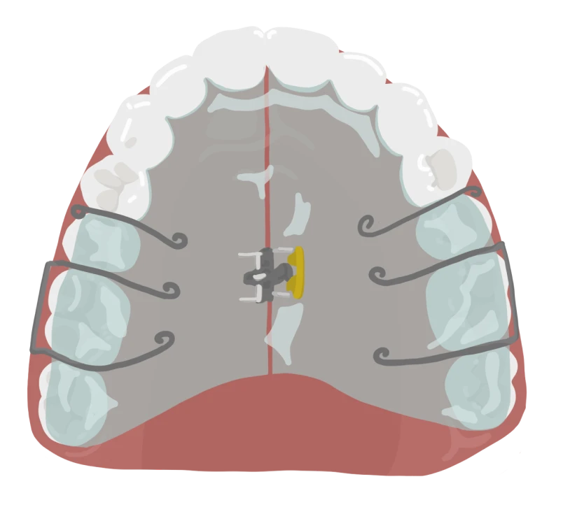 le guedard othodontiste saint gregoire appareil interception twin bloc vue haut